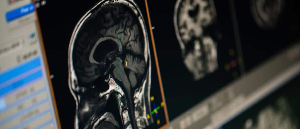 Brain scan showing changes in brain structure associated with addiction and substance use disorders